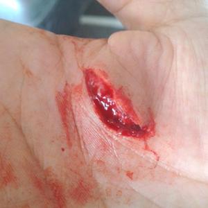 Lacerated Hand